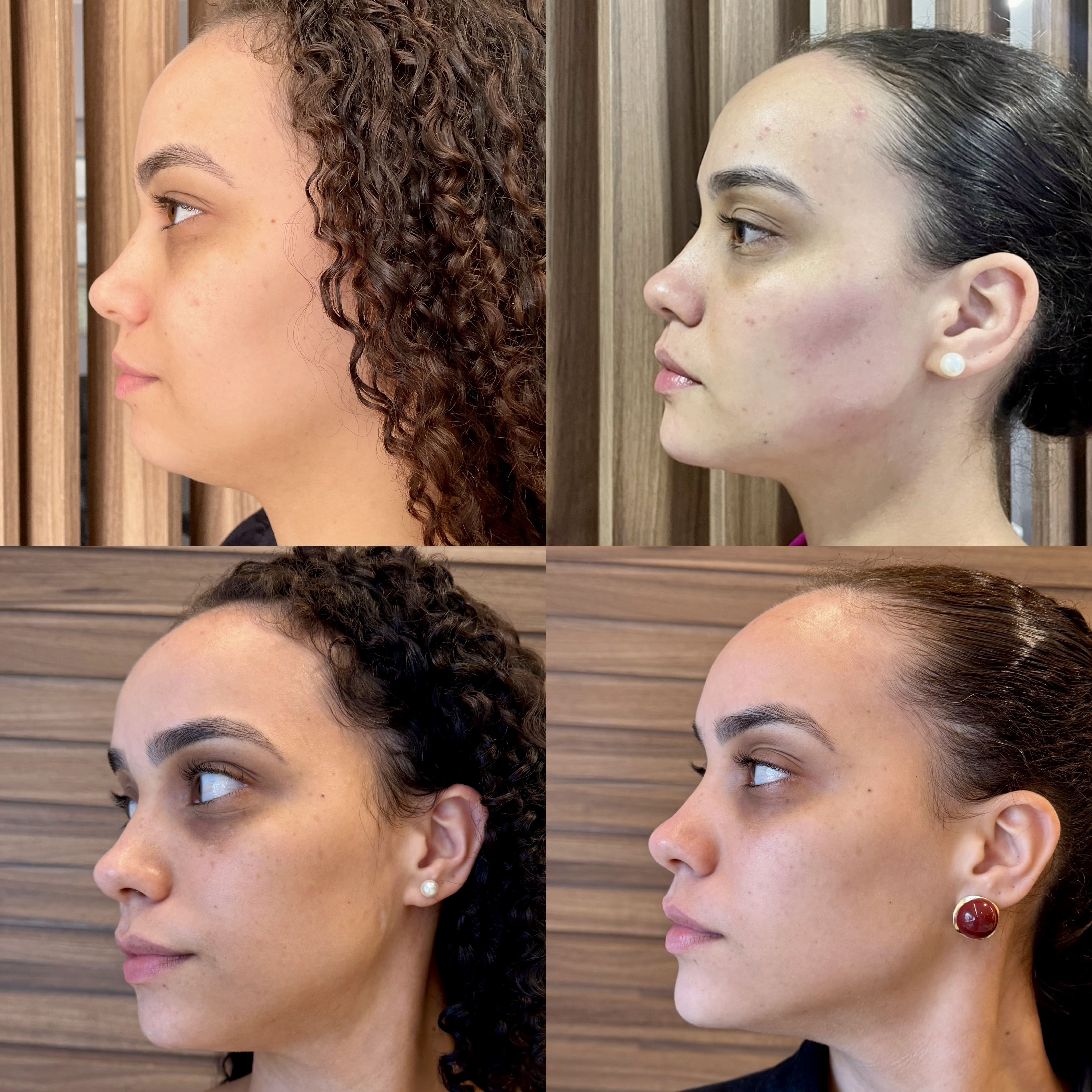 Antes e depois — contorno facial