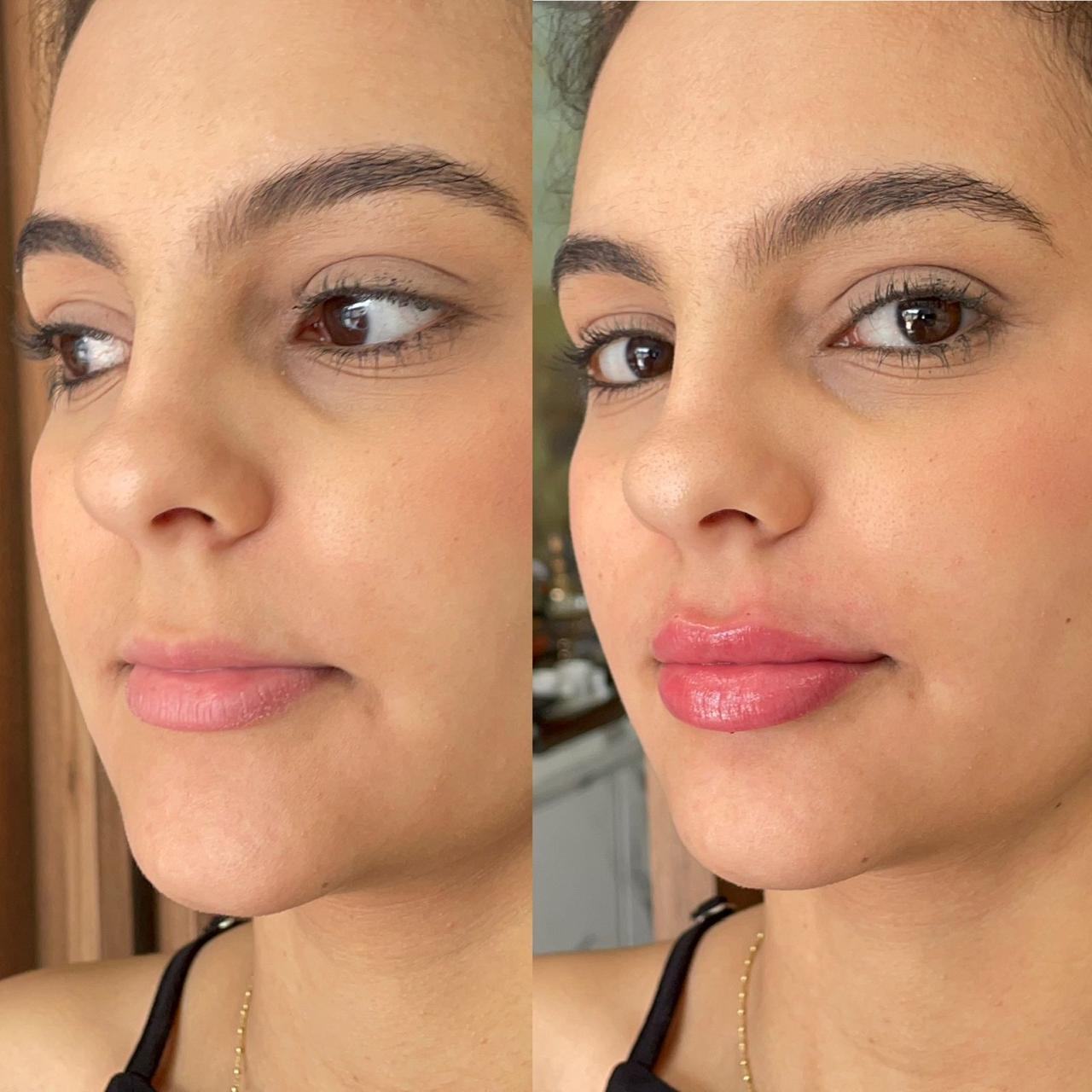 Antes e depois — preenchimento labial